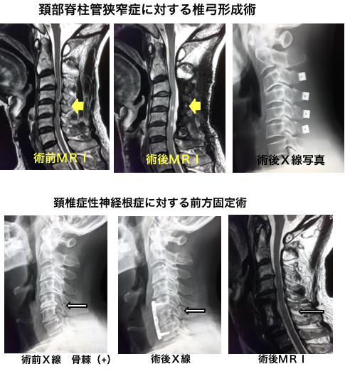 Mri 頚椎